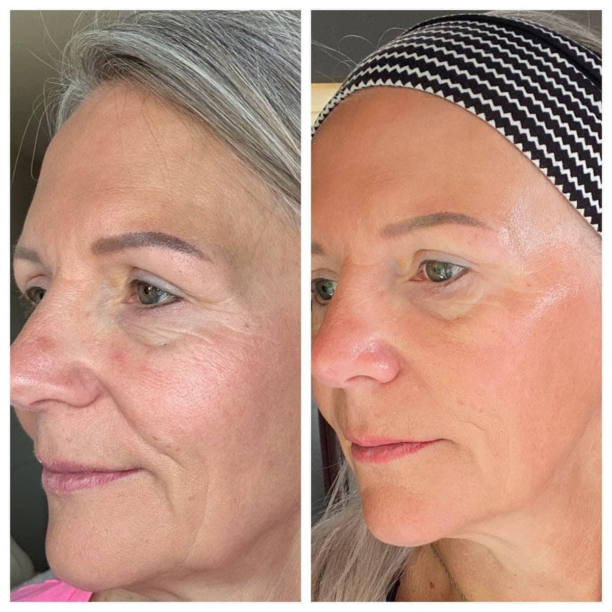 Comparaison avant après du visage d'une femme utilisant la brosse lymphatique.