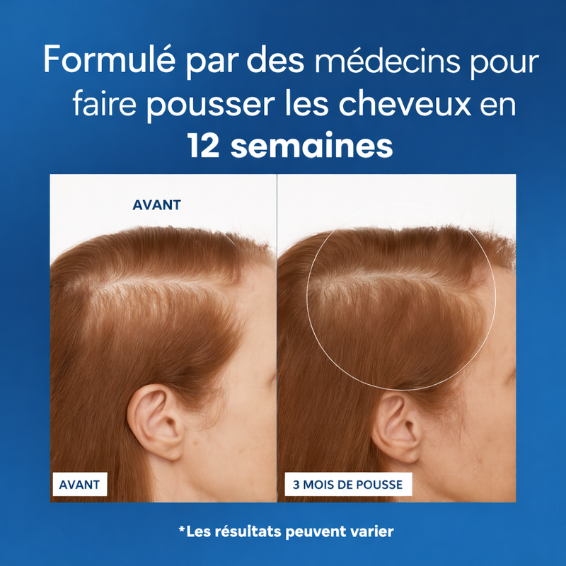 Chute de cheveux chez la femme jeune — solutions et sérum de stimulation
