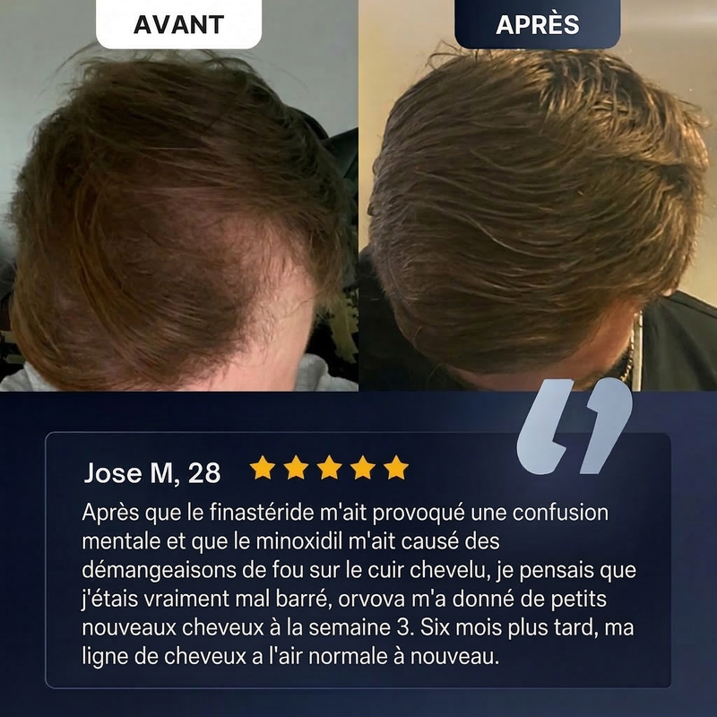 Huile de romarin vs minoxidil — sérum capillaire au romarin ORVOVA